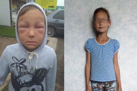 «Ребенок в критическом состоянии»: в Башкортостане 8-летнюю девочку покусали соседские пчелы