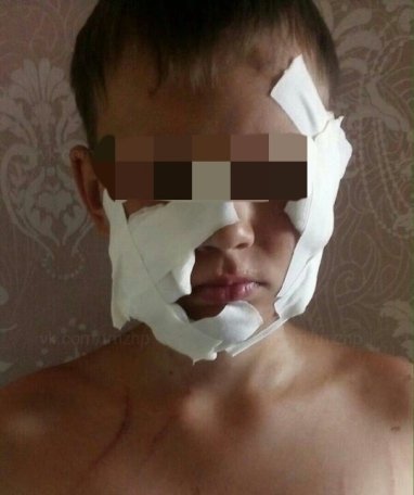 «Наложили швы на лицо под наркозом»: еще одно нападение собаки на ребенка произошло в Башкортостане