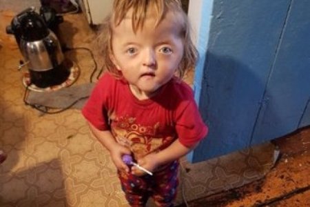 «Будет пугать детей»: в Башкортостане девочку-инвалида отказались принимать в детский садик
